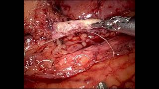 #218 Ureteroplasty with buccal mucosa graft guided by fluorescence- Drs. G. Bondonno & A. Volpe