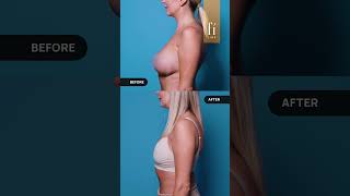 Breast Implant Removal and Breast Lift