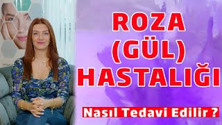 Roza (Gül) Hastalığı Nasıl Tedavi Edilir ?