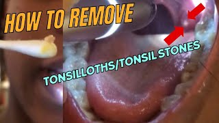 How to get rid of Tonsilloliths Tonsil Stones