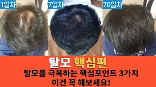 탈모약없이 탈모 극복하는 핵심포인트 3가지! 이건 꼭 해보세요!