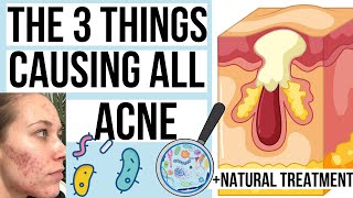 What Causes Pimples? THE 3 THINGS THAT CAUSE PIMPLES (+ Curing Acne NATURALLY)