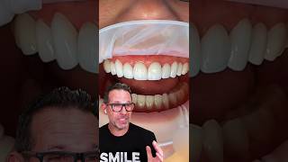 Reacting to a Stunning No Prep Veneer Smile Transformation! #veneers #noprepveneers