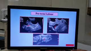 role of u/s in diagnosis of second & third trimester