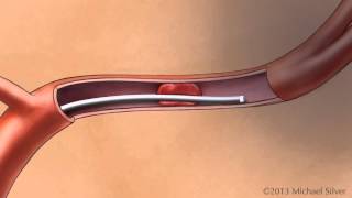 Treatment of Acute Ischemic Stroke with Clot Retrieval Device