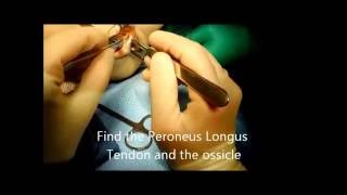 Peroneus Longus Tendon Repair by removal of painful ossicle