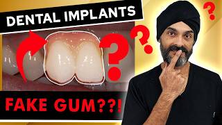 Secrets Revealed: Dental Implants with Fake Gum