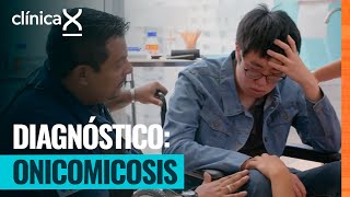 Paciente asiático llega con hongos patógenos en las uñas | Clínica X