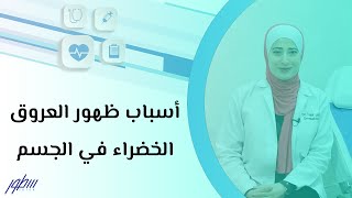 أسباب ظهور العروق الخضراء في الجسم