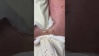 Big Cystic Acne Blackheads Extraction Blackheads & Milia, Whiteheads Removal Pimple Popping #shorts