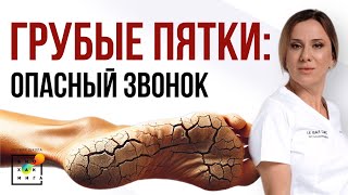 Трескаются пятки: страдает ЩИТОВИДКА? #здоровье  #пшб #иринабаранова