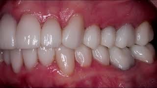 Full Mouth Rehabilitation- 28 SAME DAY Crowns