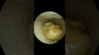 EARWAX REMOVAL BY MICROSUCTION METHOD