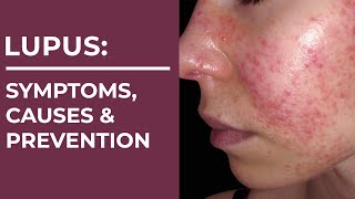 Lupus: Symptoms, Causes & Prevention Measures | Healthie Genie