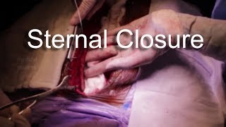 Sternotomy / Sternal Closure