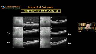 Late Night Retina ( Episode 18 ) : Macular Hole 2