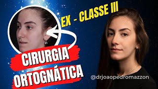 Depoimento - Cirurgia Ortognática - Classe III - Dr João Pedro Paulino Mazzon