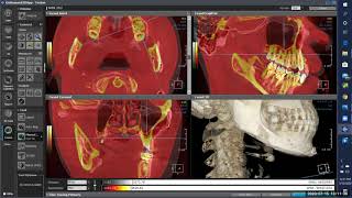 3D Superimposition feature with CBCT. HDXWILL's 6th webinar in the E-Learning Series