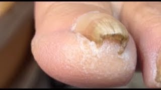 How to cut curvy toenail