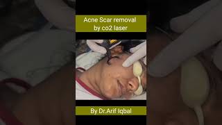 Acne Scar Removal by Co2 laser #acnescars #skincare #shorts