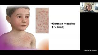 Viral Exanthemas: Measles