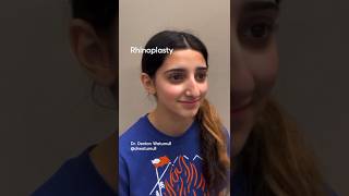 Check out this amazing Rhinoplasty transformation⁉️#rhinoplasty #nosejob #cartilagegraft