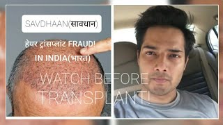 (घोटाला)Hair transplant Results||सावधान||SCAM in India ध्यान दे|| Minoxidil Finasteride| Hindi