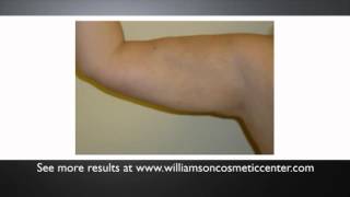 Arms - Cosmetic Surgery