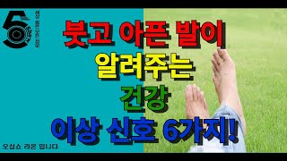 붓고 아픈 발이 알려주는 건강 이상 신호 6가지!