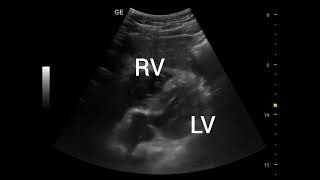 Normal Aortic valve and aortic root, subcostal ultrasound and echocardiography video