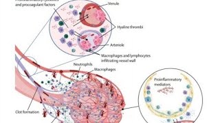 خطوره الكورتيزون وأدوية السيوله فى الكوروناcortisone and covid 19