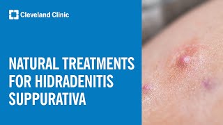 Natural Treatment Options for Hidradenitis Suppurativa