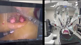 Robotic-Assisted Radical Prostatectomy Training - 3D models