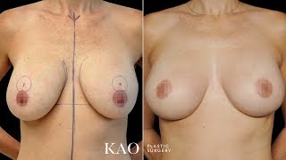 Breast Lift with no "Inverted T Scars." Dr. Kao's Alexandra Breast Lift