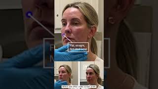 Cheek Filler: Voluma by Dr. Damico