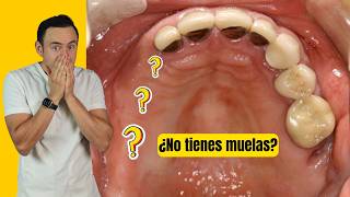 Esto le pasa a tu cuerpo al perder las muelas | ¡Te quedarás con la boca abierta!