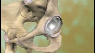 Medical animation. Hip arthroplasty p.1