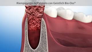 Trattamento conservazione ossea dopo estrazione