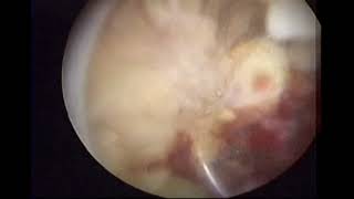 hysteroscopic resection of placental remnants after percreta surgery