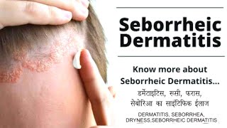 Seborrheic Dermatitis and Its Approach explained by Dr Makkar | सेबरेरिक डार्माटाइटिस डैंड्रफ hindi