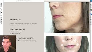 Introducing two new fillers:  Revanesse Versa and Lips+ and discussion of fillers & lip enhancement