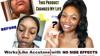 Natural Cystic Acne Cure in 2 Weeks! + My Acne Journey