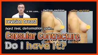 What is capsular contracture and how can it be treated? CASE STUDY by Korean plastic surgeon.