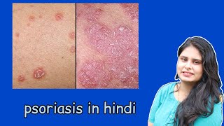 Psoriasis in Hindi | clinical feature , investigation,  types | Psoriasis quick revision