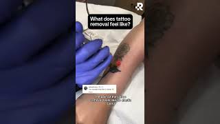 What does laser tattoo removal at Removery feel like?🧐