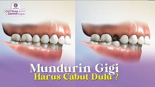 APAKAH MEMUNDURKAN GIGI MAJU PASTI CABUT GIGI ?