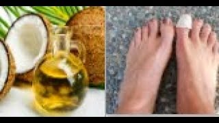 Coconut oil+Tea Tree oil.. the best natural remedies against the spread of nail fungus