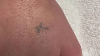 Stick and poke tattoo, laser tattoo removal, female hand