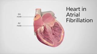 GSAAF Heart in Atrial Fibrillation