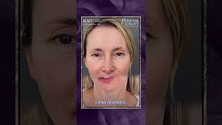 Ponytail Facelift: Plastic Surgery Results Part 5 At Kao Plastic Surgery #facelift #beforeandafter